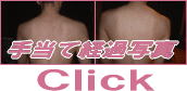 背中ニキビ、胸にきび、体ニキビの経過写真